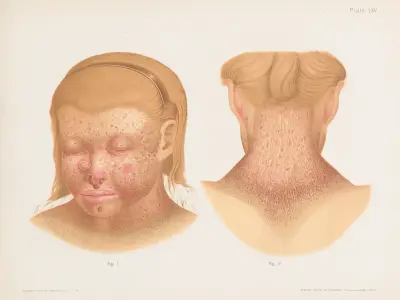 I. and II. Xeroderma pigmentosum av Prince Albert Morrow