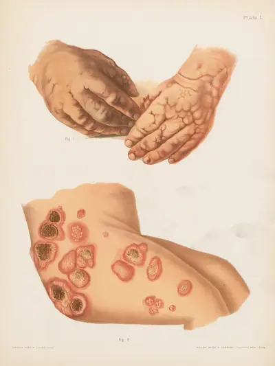 I. Bullous eruption of the hands produced by iodide of potassium, II. Ulcerating hydroa from bromide of potassium av Prince Albert Morrow
