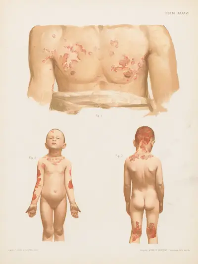 I. Eczema seborrhoicum of the breast and arms, II. and III. Eczema seborrhoicum universale av Prince Albert Morrow