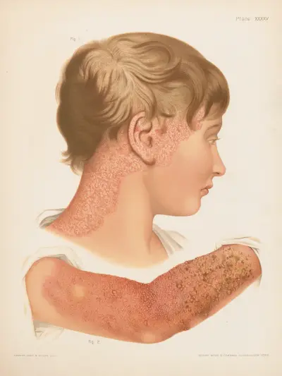 I. Eczema squamosum, II. Eczema papulosum, vesiculosum et impetiginosum av Prince Albert Morrow