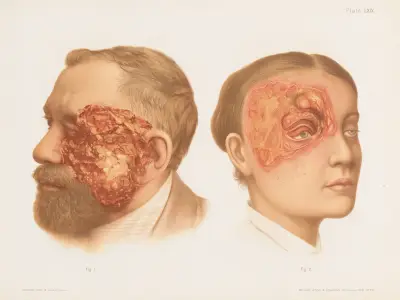 I. Epithelioma, II. Rodent Ulcer av Prince Albert Morrow