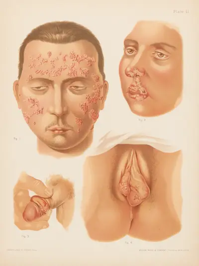I. Herpes zoster (double), II. Herpes febrilis, III. Herpes of male genitals, IV. Herpes of female genitals av Prince Albert Morrow