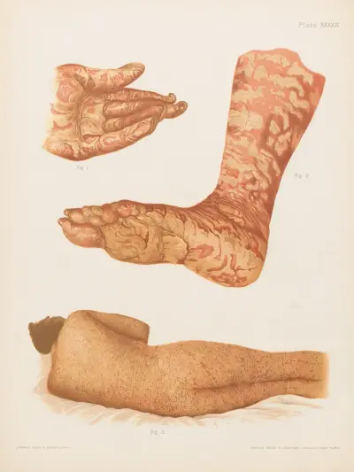 I. Pityriasis rubra of the leg and sole, II. Pityriasis rubra of the palm and nails, III. Dermatitis exfoliativa av Prince Albert Morrow