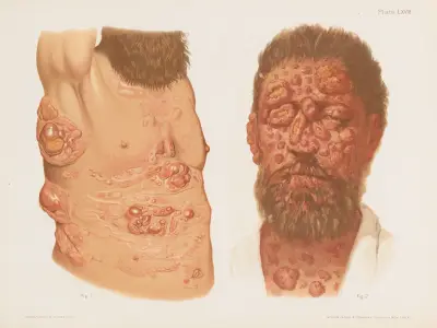 I. Sarcoma of Trunk, II. Sarcoma of Face and Chest av Prince Albert Morrow