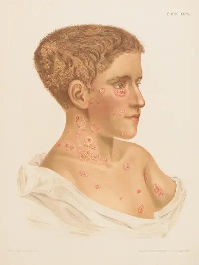 Tricophytosis and Favus av Prince Albert Morrow