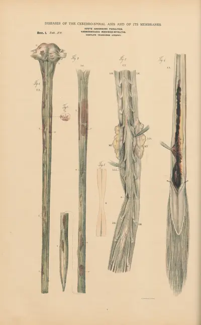 Acute ascending paralysis av Jean Allard Jeancon