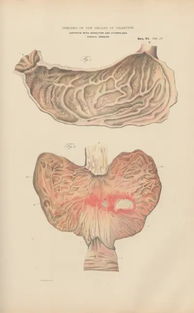 Acute catarrhal Gastritis, and hyperplasia av Jean Allard Jeancon