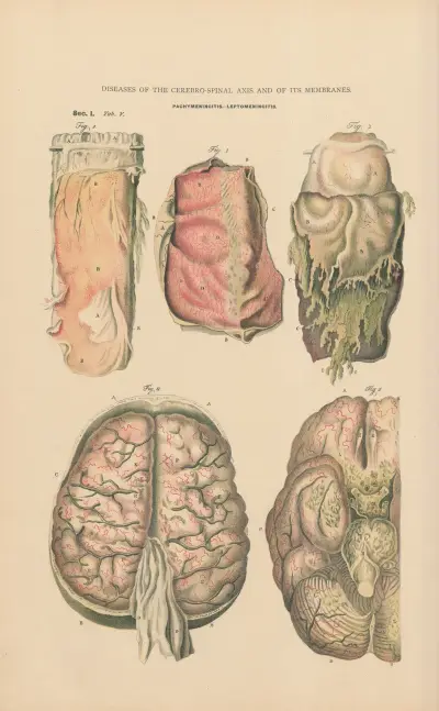 Akut hemorragisk pachymeningit och leptomeningit av Jean Allard Jeancon