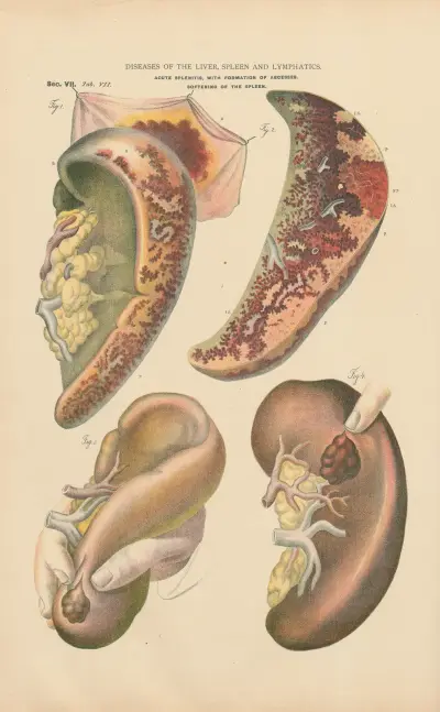 Acute splenitis, with formation of abcesses av Jean Allard Jeancon