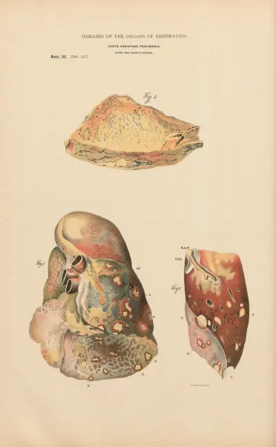 Astenisk pneumoni med abscesser i lungorna av Jean Allard Jeancon