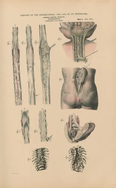 Kronisk central myelit. Hydromyelus, Spina bifida av Jean Allard Jeancon