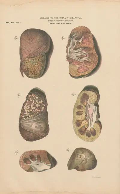 Chronic Nephritis and induration av Jean Allard Jeancon