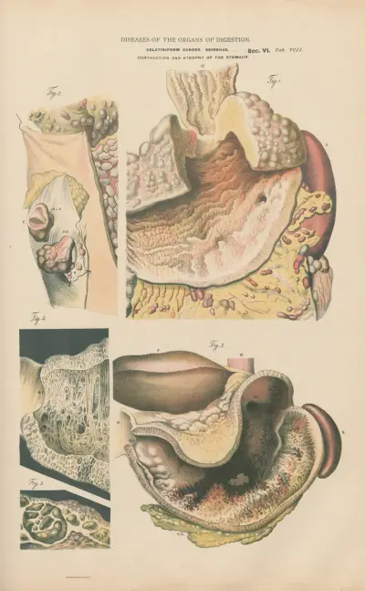 Colloid of stomach av Jean Allard Jeancon