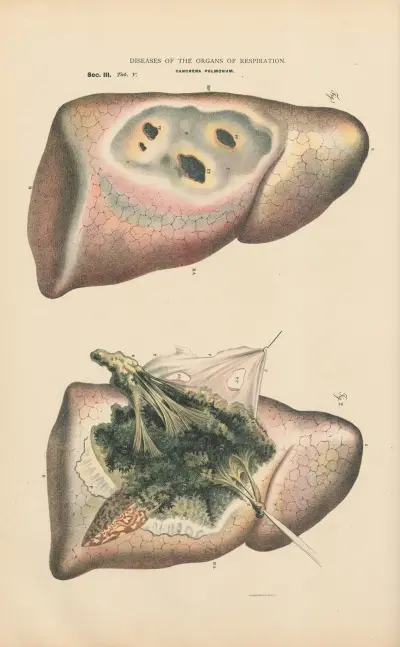 Diffuse Gangrene of right lung av Jean Allard Jeancon