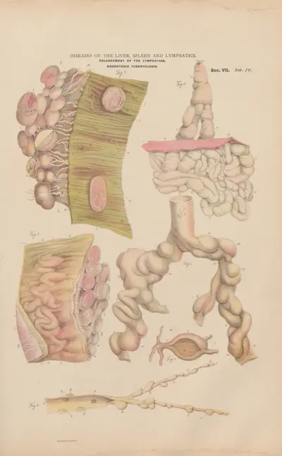 Dilatation and hypertrophy of thoracic duct av Jean Allard Jeancon