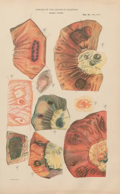 Enteric Typhoid av Jean Allard Jeancon