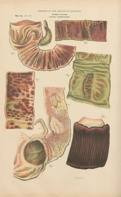 Epidemic Cholera av Jean Allard Jeancon