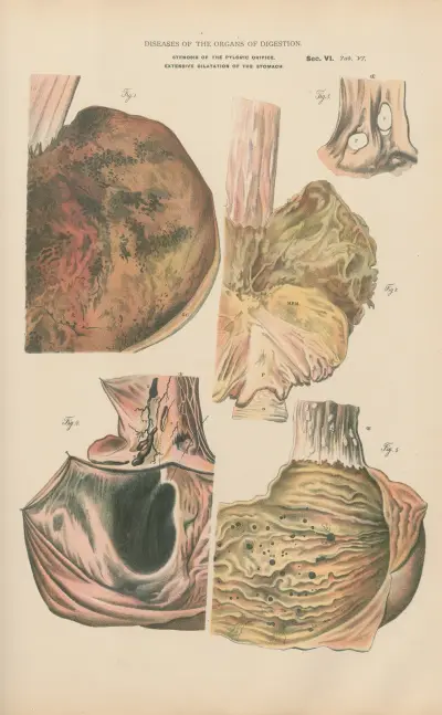 Gastric Lesions. Extensive delatation av Jean Allard Jeancon
