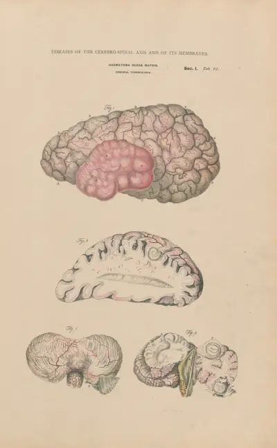 Haematoma. Tubercular meningitis av Jean Allard Jeancon