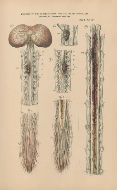 Haemomyelitis and descending paralysis av Jean Allard Jeancon