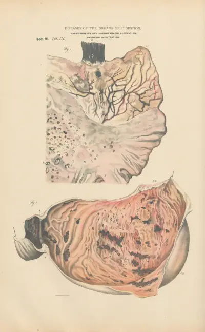 Haemorrhage and haemorrhagic infiltration into the mucous membranes of the stomach av Jean Allard Jeancon