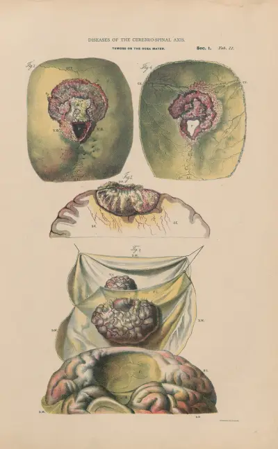 Hemiplegi, kancerösa tumörer i dura mater. Uppluckring av hjärnsubstans av Jean Allard Jeancon