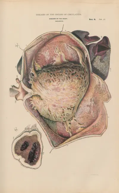 Hydro-pericarditis av Jean Allard Jeancon