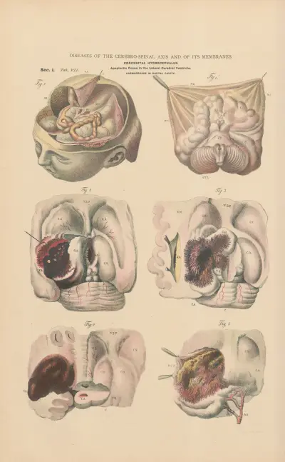 Hydrocephalus and microcephalus av Jean Allard Jeancon