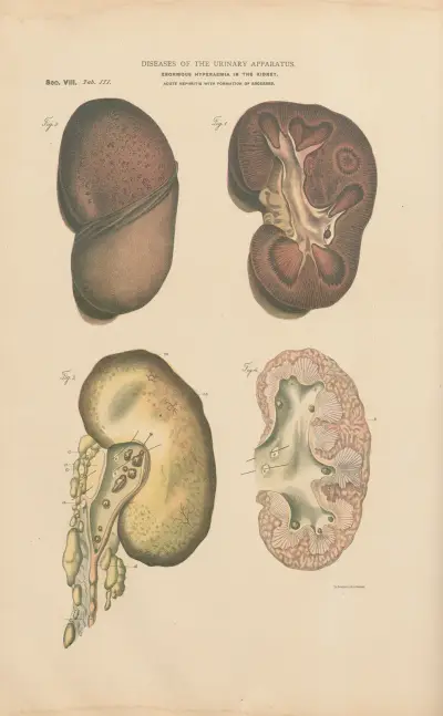 Hyperæmia and enlargement of kidney av Jean Allard Jeancon