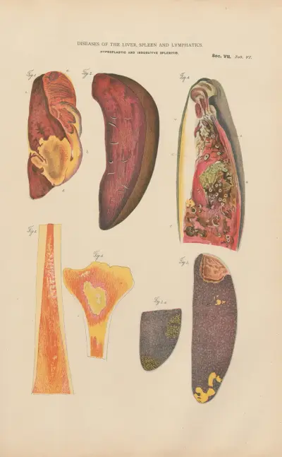 Hyperplastic and indurative splenitis av Jean Allard Jeancon