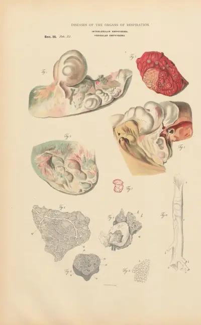 Interlobular pulmonic Emphysema av Jean Allard Jeancon
