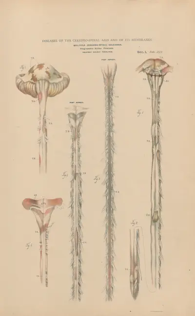 Multiple cerebro-spinal sclerosis, progressive bulbar paralysis. Incipient bulbar paralysis av Jean Allard Jeancon