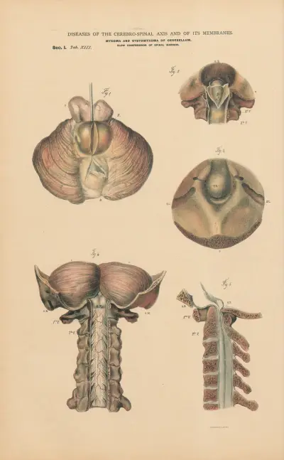 Myxomata in cerebellum. Slow compression of spinal cord, by displacement of Atlas av Jean Allard Jeancon