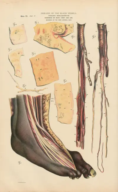 Purulent endoarteriit i femoralartären av Jean Allard Jeancon