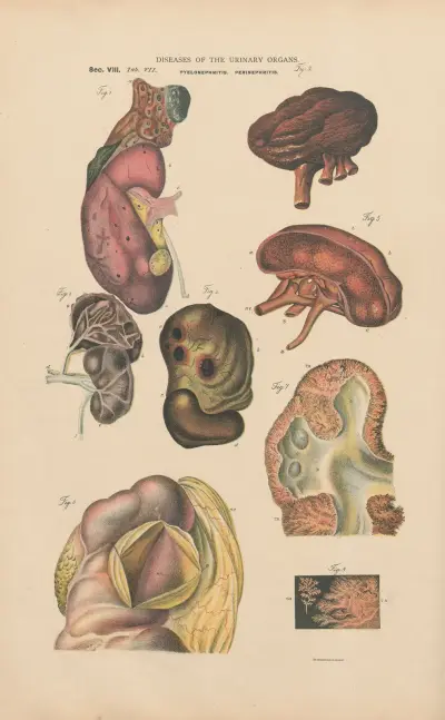 Pyelonephritis and extensive suppuration av Jean Allard Jeancon
