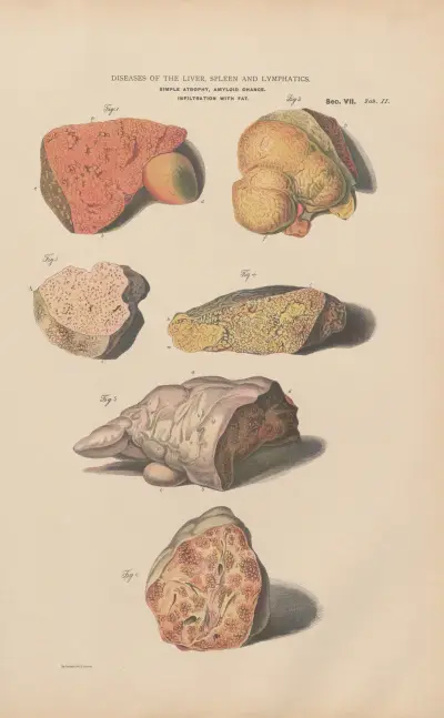 Red atrophy of liver, indurative hypertrophy av Jean Allard Jeancon