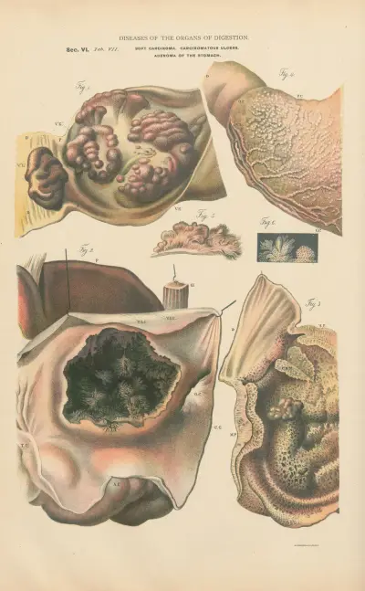 Soft Epithelioma of the Stomach av Jean Allard Jeancon
