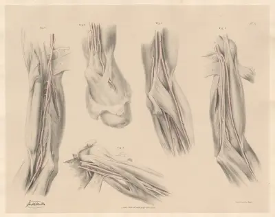 Deviations of one of the two arteries representing the brachial av Joseph Maclise