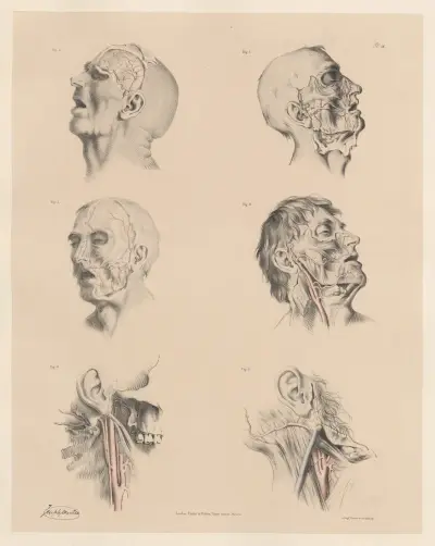 Zvláštnosti větví zevní krkavice, Joseph Maclise