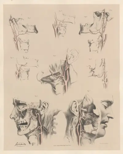 Egenheter hos de yttre halspulsådrornas grenar av Joseph Maclise