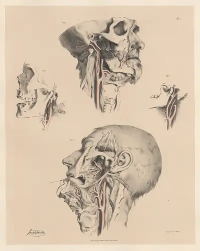 Egenheter hos de yttre halspulsådrornas grenar av Joseph Maclise