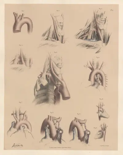 Peculiarities of the Subclavian arteries—affecting the trunk av Joseph Maclise