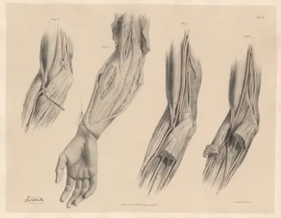 Sällsynta avvikelser i ulnarartären, egenheter i brachialartären av Joseph Maclise