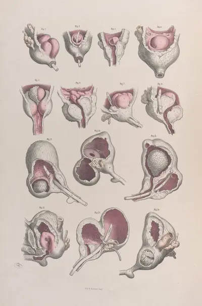 Surgical anatomy Pl.46 av Joseph Maclise