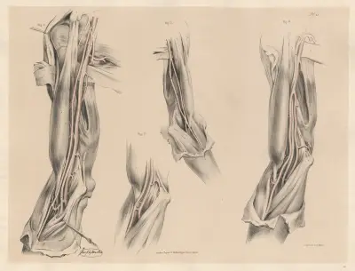 Armhåls- eller armartärerna, delade i två grenar av Joseph Maclise