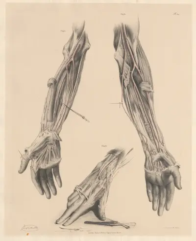 The Interosseous joins in different cases with the other two arteries of the fore-arm av Joseph Maclise