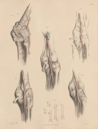 Poplitealartären och dess egenheter av Joseph Maclise