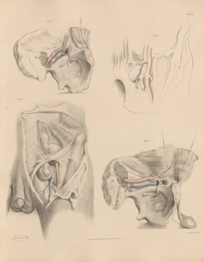 The various relations of the Obturator artery to different kinds of hernia av Joseph Maclise