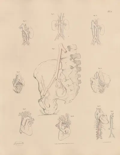 Unusual conformation of the Iliac arteries av Joseph Maclise