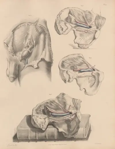 Various conditions of the Obturator artery, The Epigastric in connexion with a hernia av Joseph Maclise